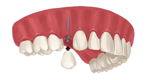Single Dental Implants Houston