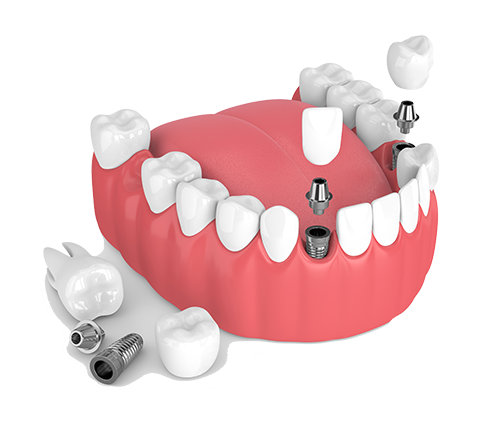 Multiple Teeth Dental Implants in Houston