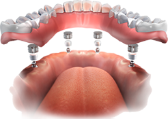 Implant Supported Removable Dentures